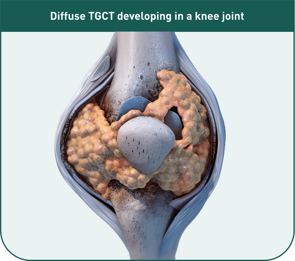 Diffuse TGCT developing in a knee joint